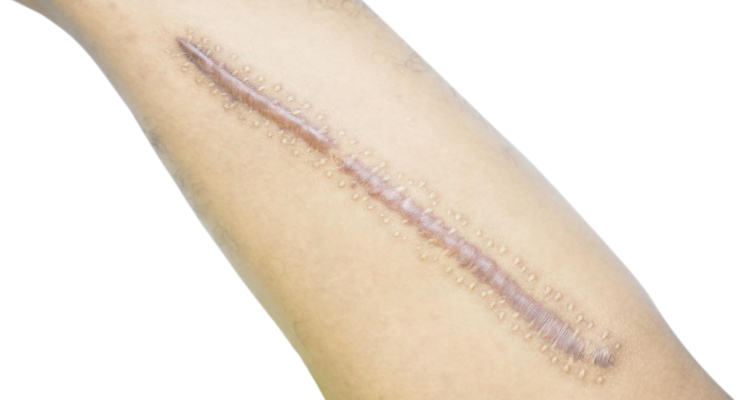 اسکار برجسته زخم چاقو