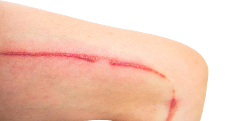 اسکار صاف یا طبیعی زخم چاقو