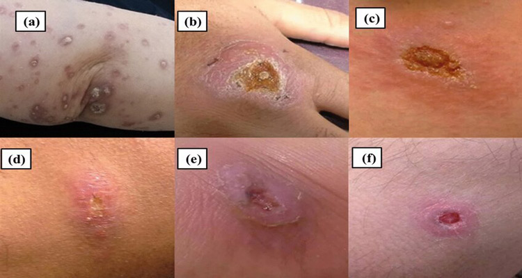 آشنایی با انواع اسکار سالک