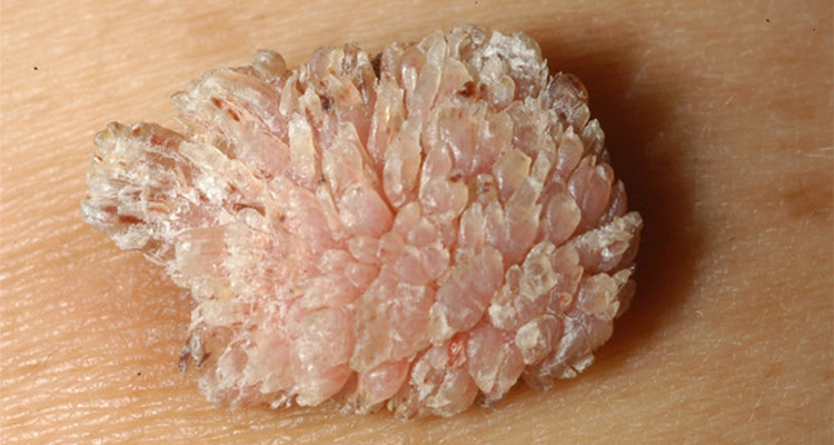 ویروس HPV در زنان و مردان چه علائمی دارد؟