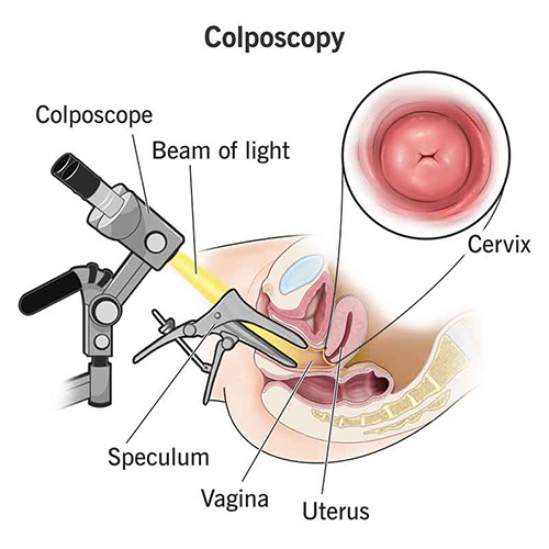 کولپوسکوپی (Colposcopy)