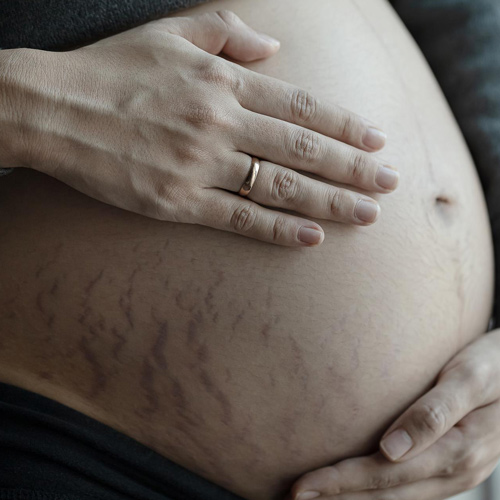 ترک پوستی ناشی از بارداری