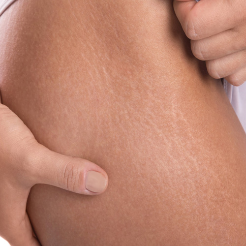 ترک پوستی در ناحیه ران پا