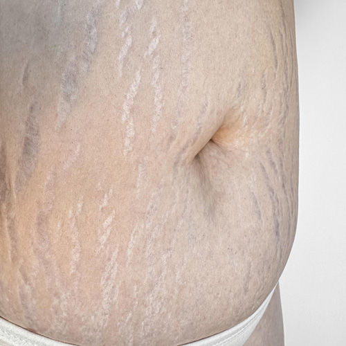 ترک پوستی سفید در ناحیه شکم