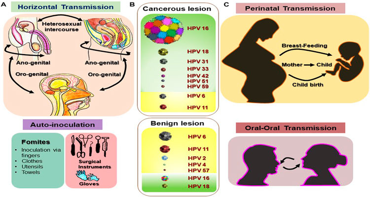 آشنایی با روش های انتقال زگیل تناسلی