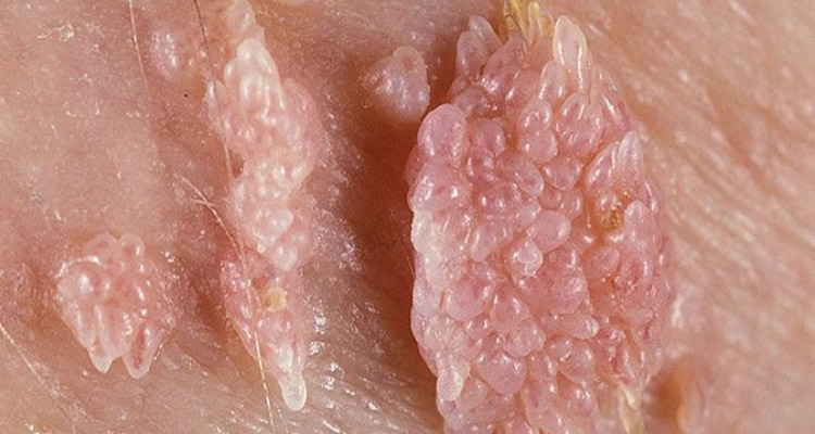 زگیل تناسلی (Genital Warts)