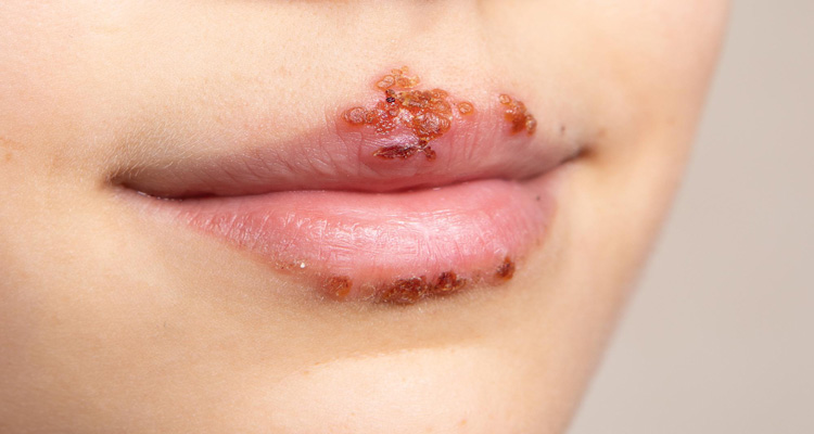 تبخال لب ناشی از HSV-1