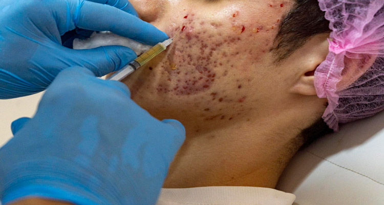 درمان اسکار فرورفته (آتروفیک) با روش PRP و PRF