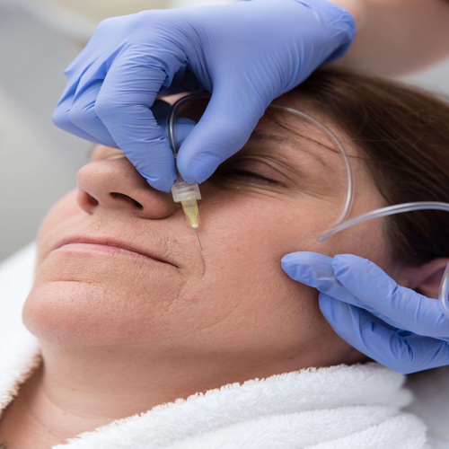 نحوه درمان اسکار با کربوکسی تراپی