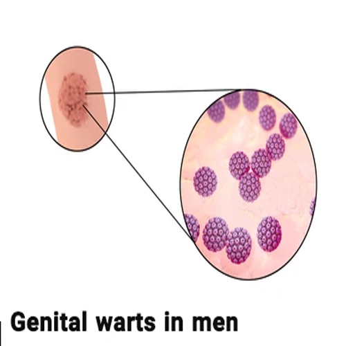 علت زگیل تناسلی بدون رابطه در مردان