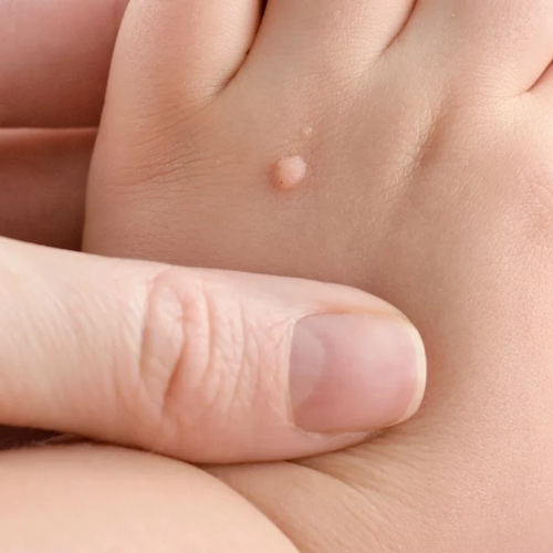 زگیل‌های پوستی در نوزاد