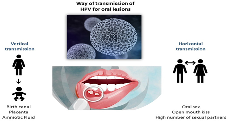 چرا افراد به زگیل دهانی مبتلا می‌شوند؟