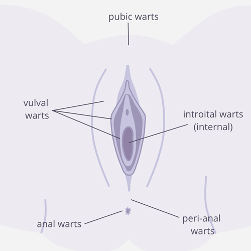 محل ظاهر شدن زگیل‌های تناسلی در زنان