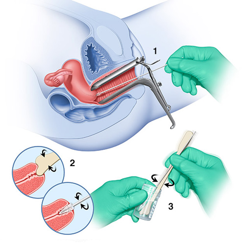 چگونه می‌توان HPV و زگیل تناسلی را در زنان تشخیص داد؟