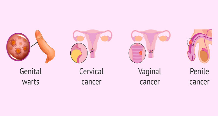 آشنایی با انواع سرطان‌هایی که با HPV و زگیل تناسلی مرتبط هستند