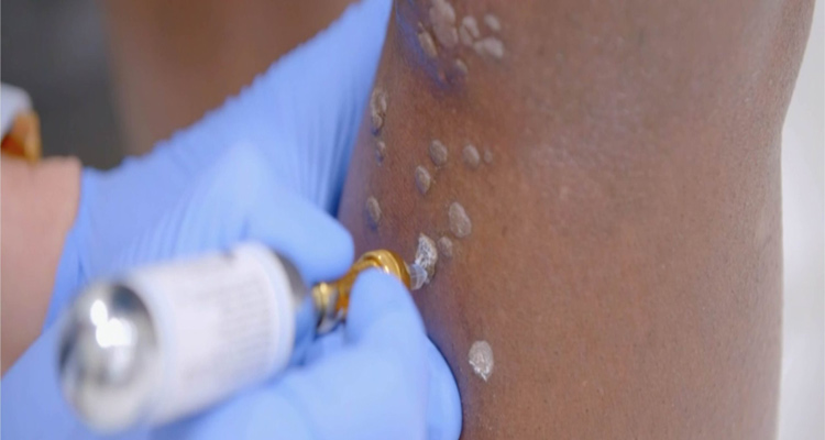 درمان اسکار برجسته با کرایوسرجری