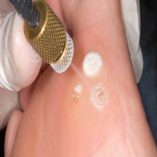 نحوه درمان اسکار به روش کرایوسرجری