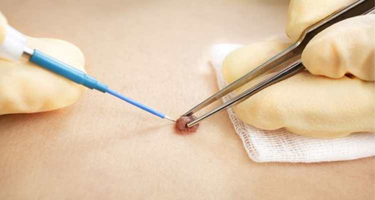 مراقبت های بعد از درمان زگیل تناسلی