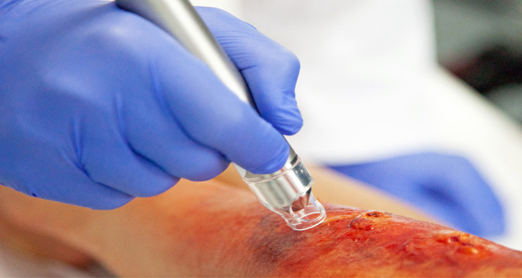 درمان اسکار با پلاسما تراپی