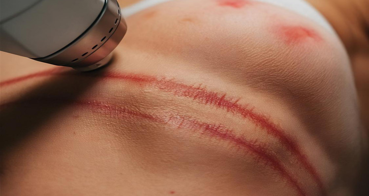 درمان اسکار با لیزر