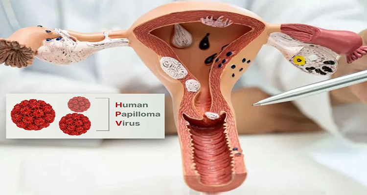 آیا زگیل تناسلی باعث سرطان می‌شود؟
