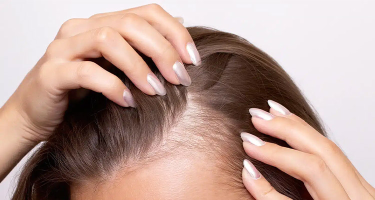 علائم ریزش مو هورمونی و درمان آن