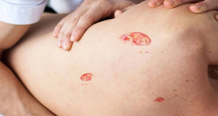 برای جلوگیری از زخم بستر چه باید کرد