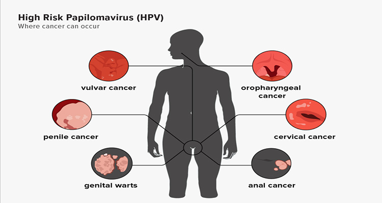 خطرات و عوارض ویروس HPV و زگیل تناسلی