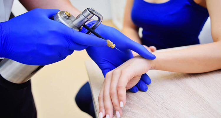 درمان اسکار به روش کرایوسرجری