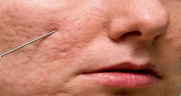 درمان اسکار با روش سابسیژن