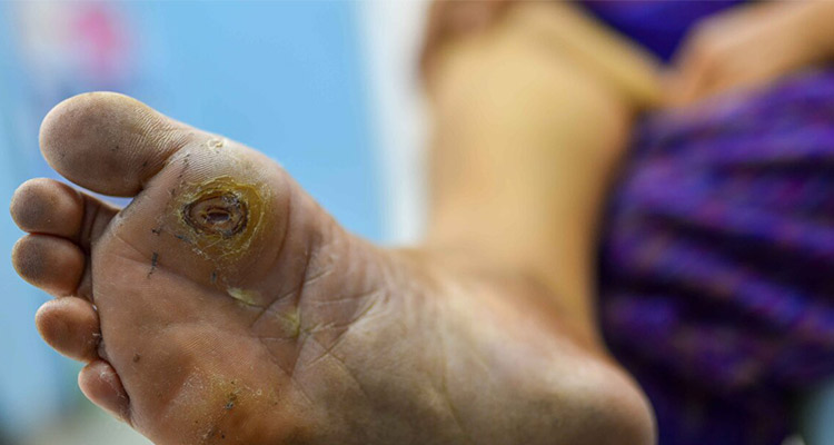 درمان عفونت زخم دیابتی