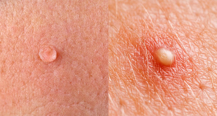 تفاوت جوش و زگیل تناسلی