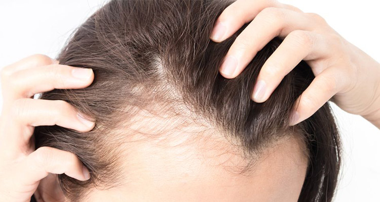 انواع مختلف ریزش مو