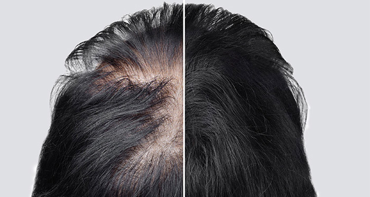 ریزش مو ناشی از استرس چگونه است؟