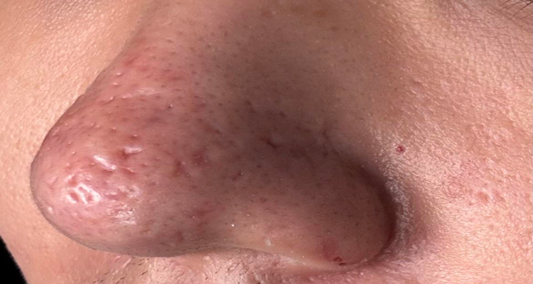 اسکار بینی چیست؟