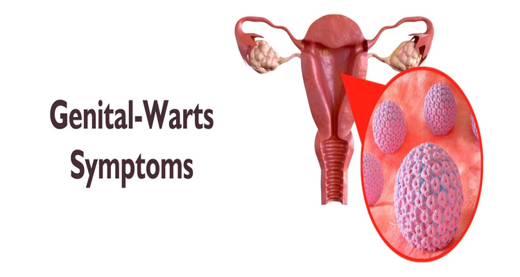 علائم و نشانه‌های زگیل تناسلی زنان