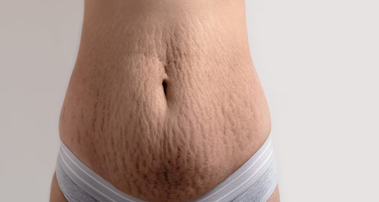 ترک پوستی چیست و چگونه می‌توان آن را درمان نمود؟