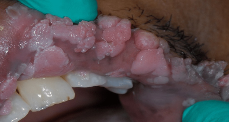 زگیل دهانی چیست؟