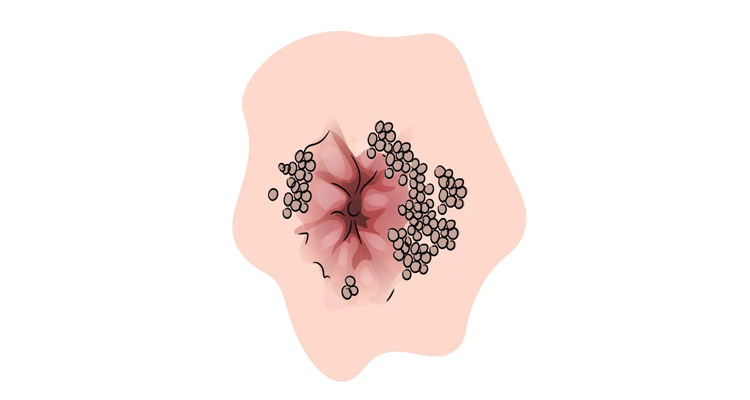 زگیل تناسلی مقعدی چیست؟ آیا همان HPV است؟